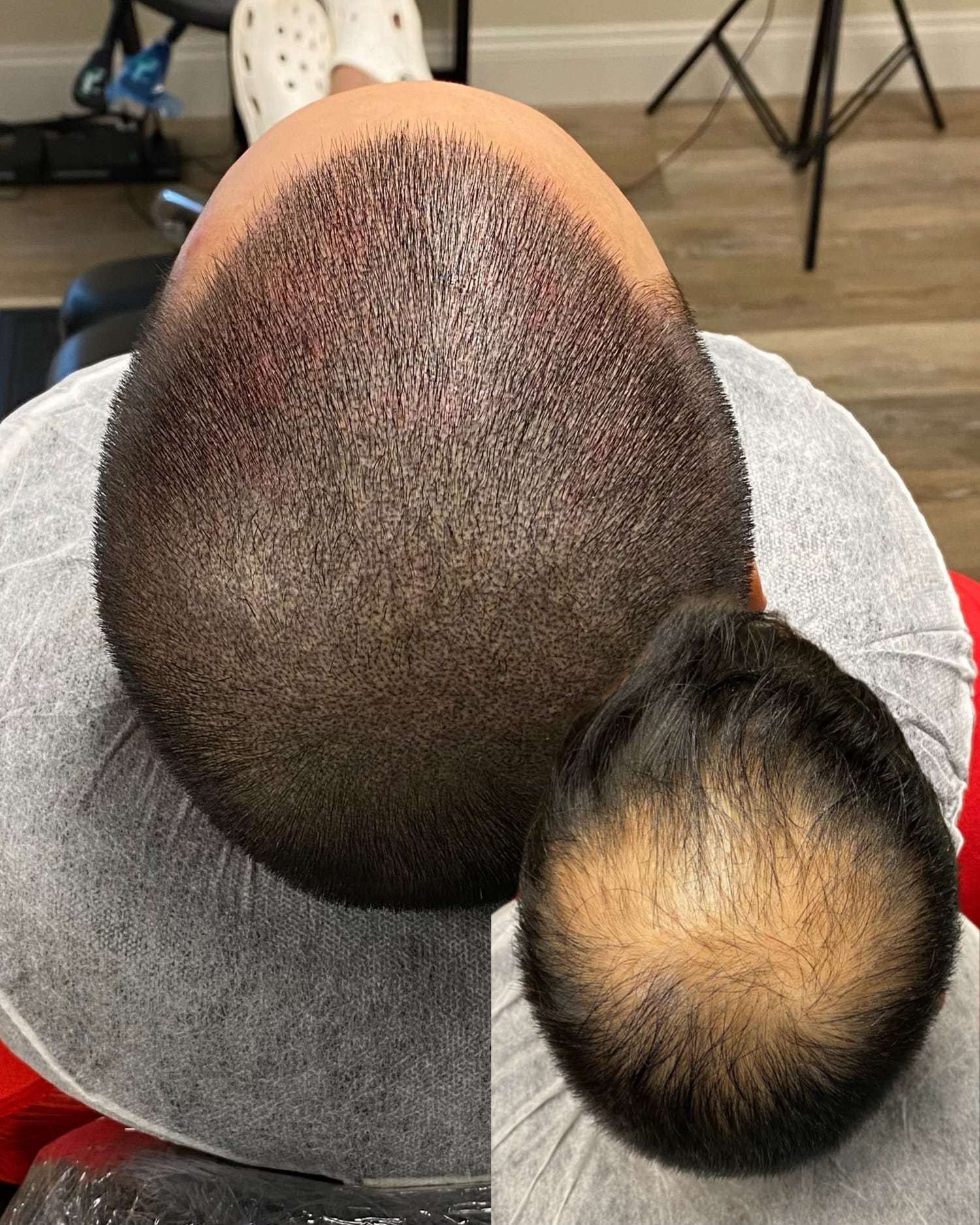 Scalp micropigmentation covering thinning areas, with a before photo of the scalp