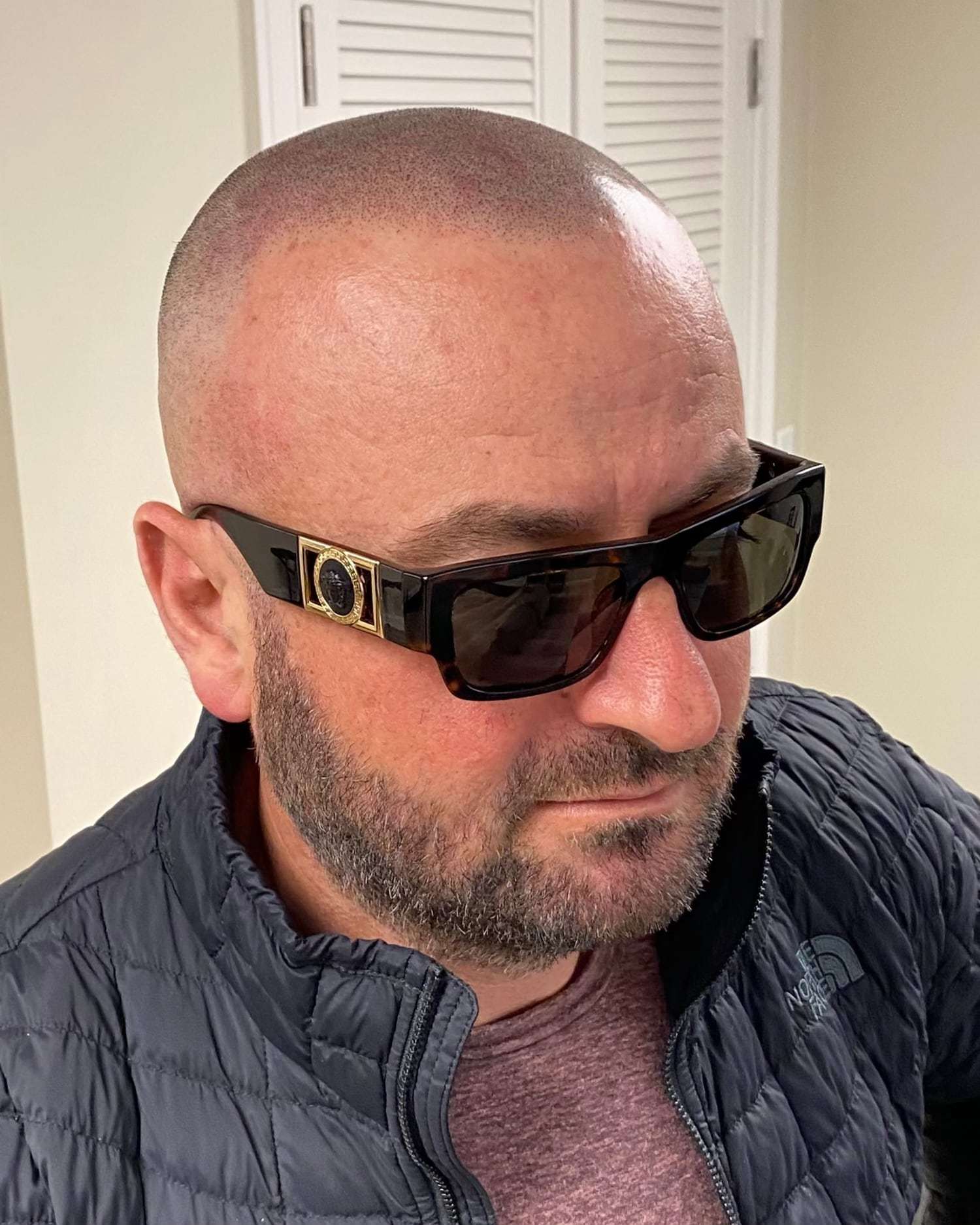 A man with a shaved head wearing sunglasses after scalp micropigmentation