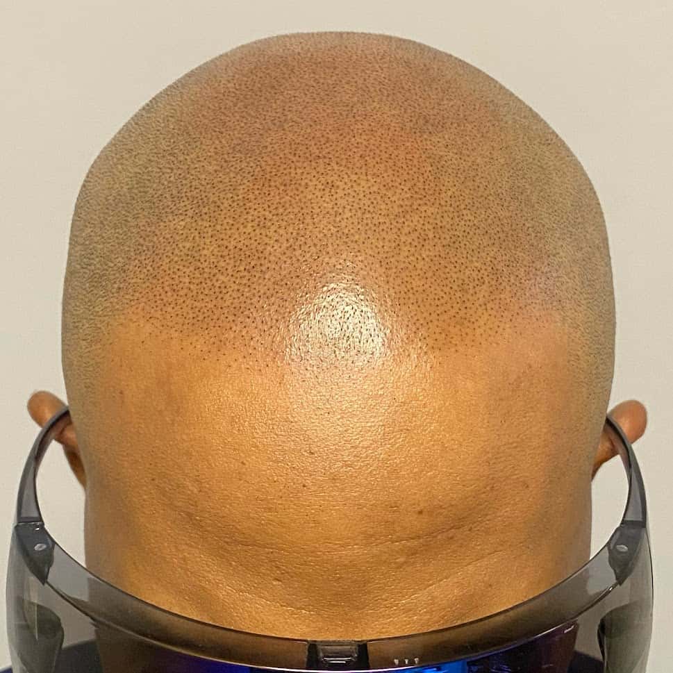 Top view of a shaved head with healed scalp micropigmentation across the crown, with protective eyewear resting below