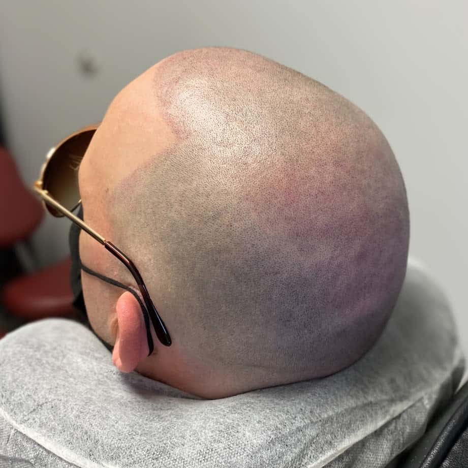 Back and side view of a client lying back during a scalp micropigmentation programme, with fresh pigment across the scalp