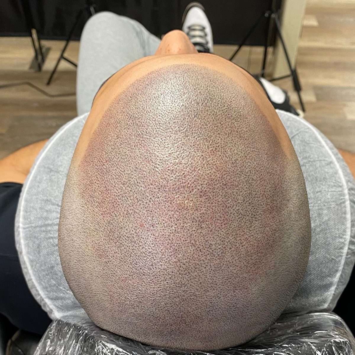Top view of a freshly treated shaved scalp showing even micropigmentation dots, taken from above in the treatment chair