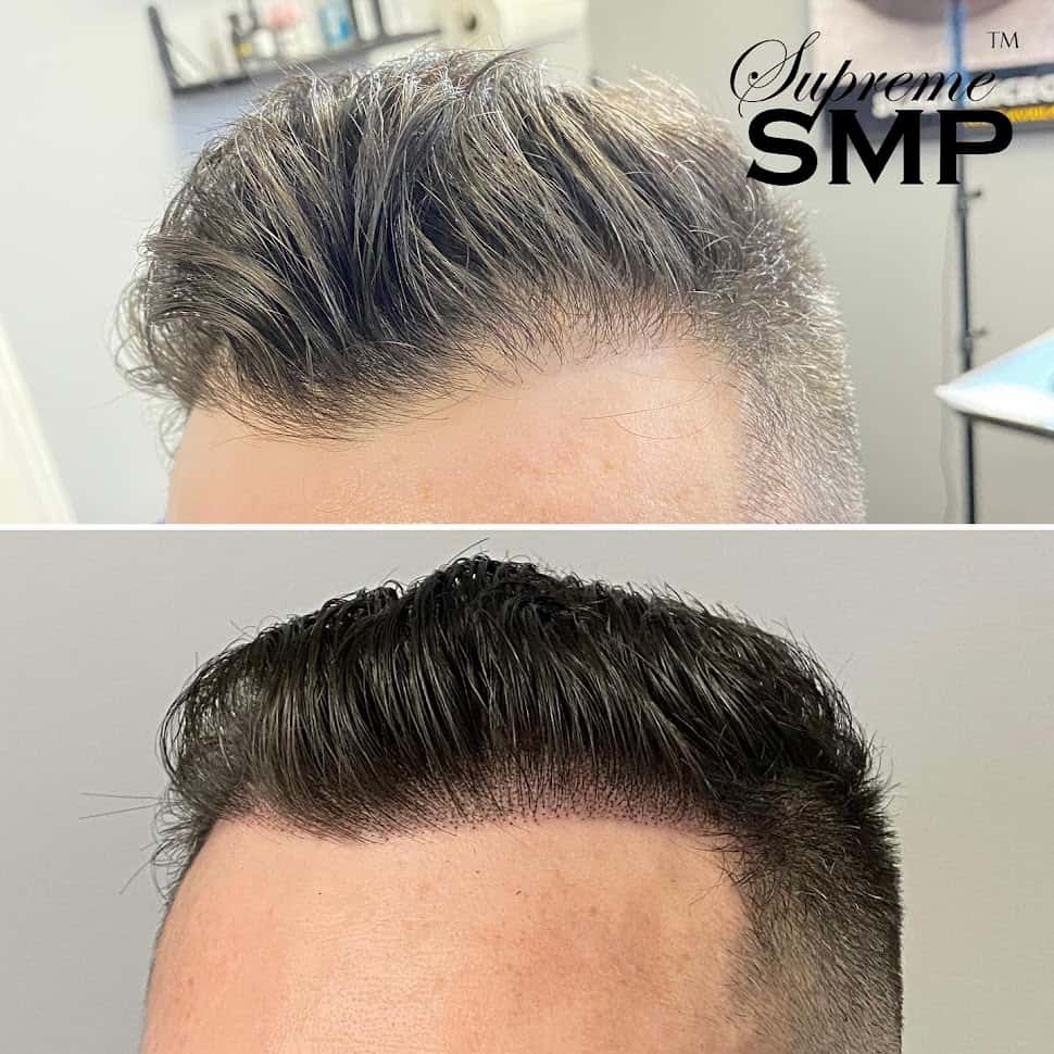 Before and after of a man’s hairline: thinning at the front, then a fuller, denser hairline after scalp micropigmentation