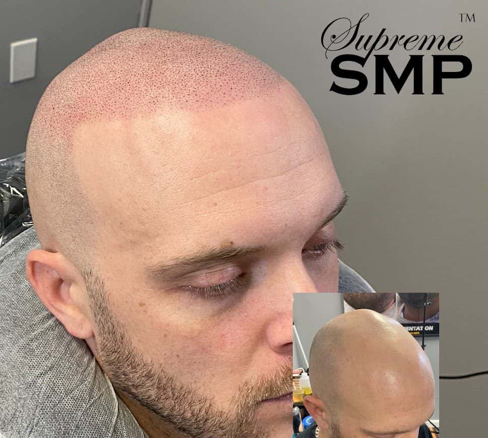 A client with fair skin shortly after scalp micropigmentation, with a healed result shown in the inset
