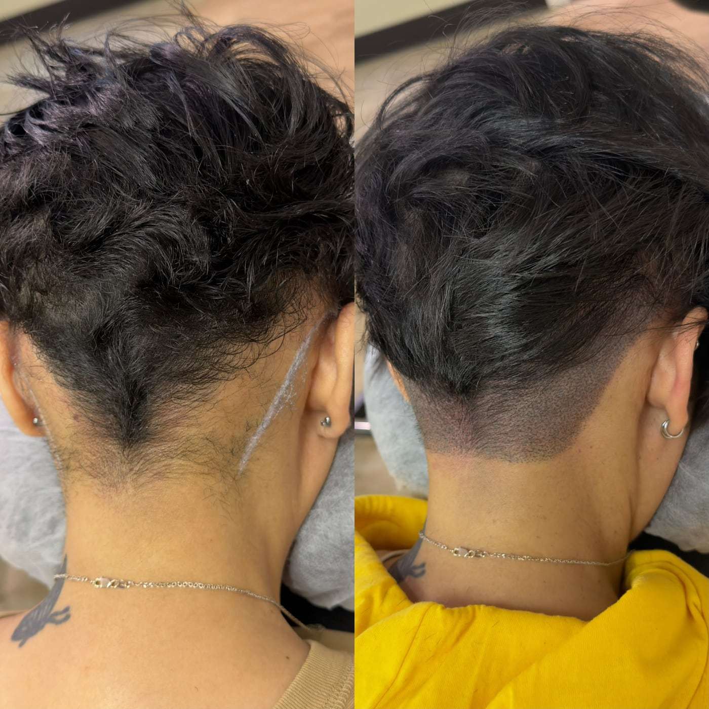 Scalp micropigmentation alopecia, before and after (1 of 4)