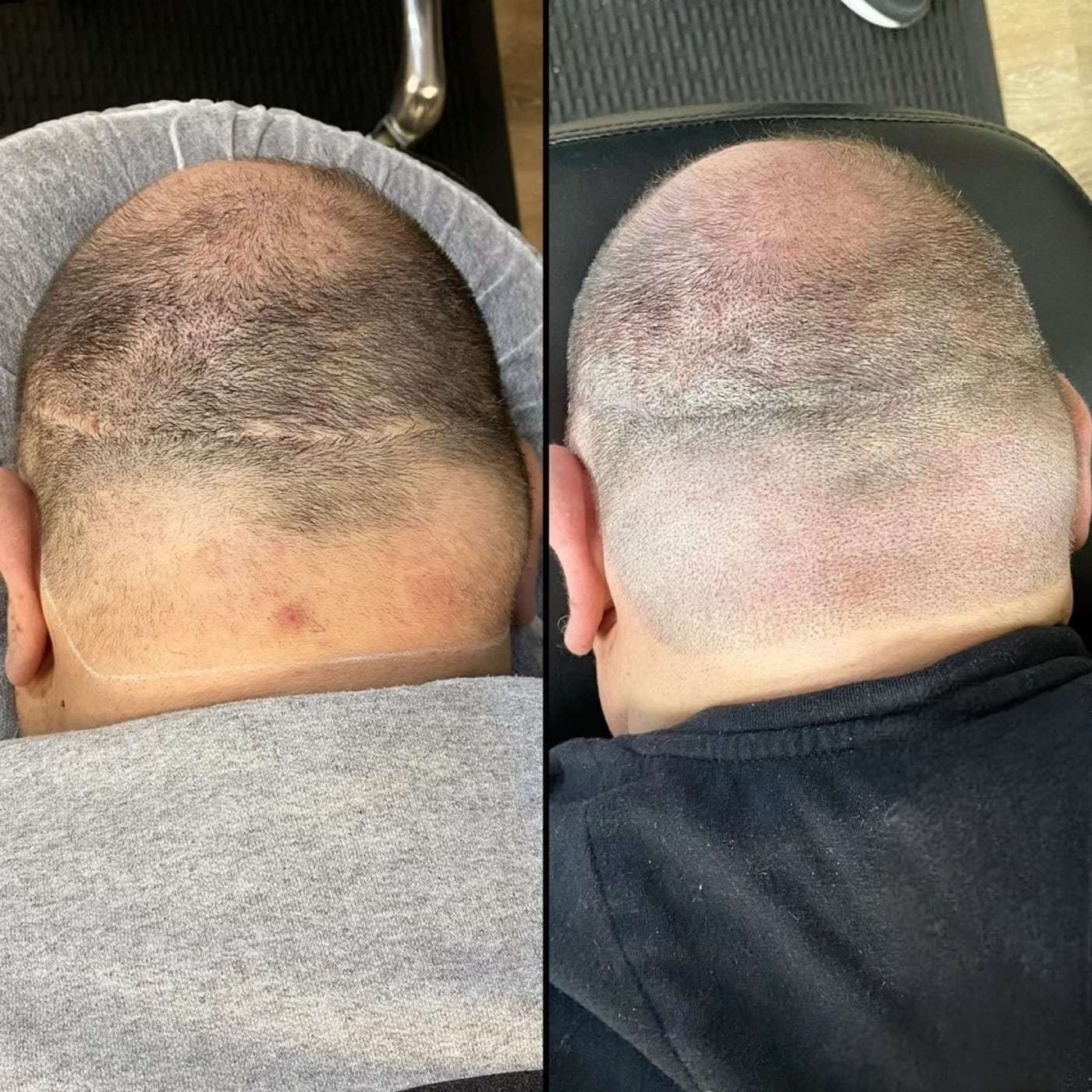 Scalp micropigmentation alopecia, before and after (2 of 4)
