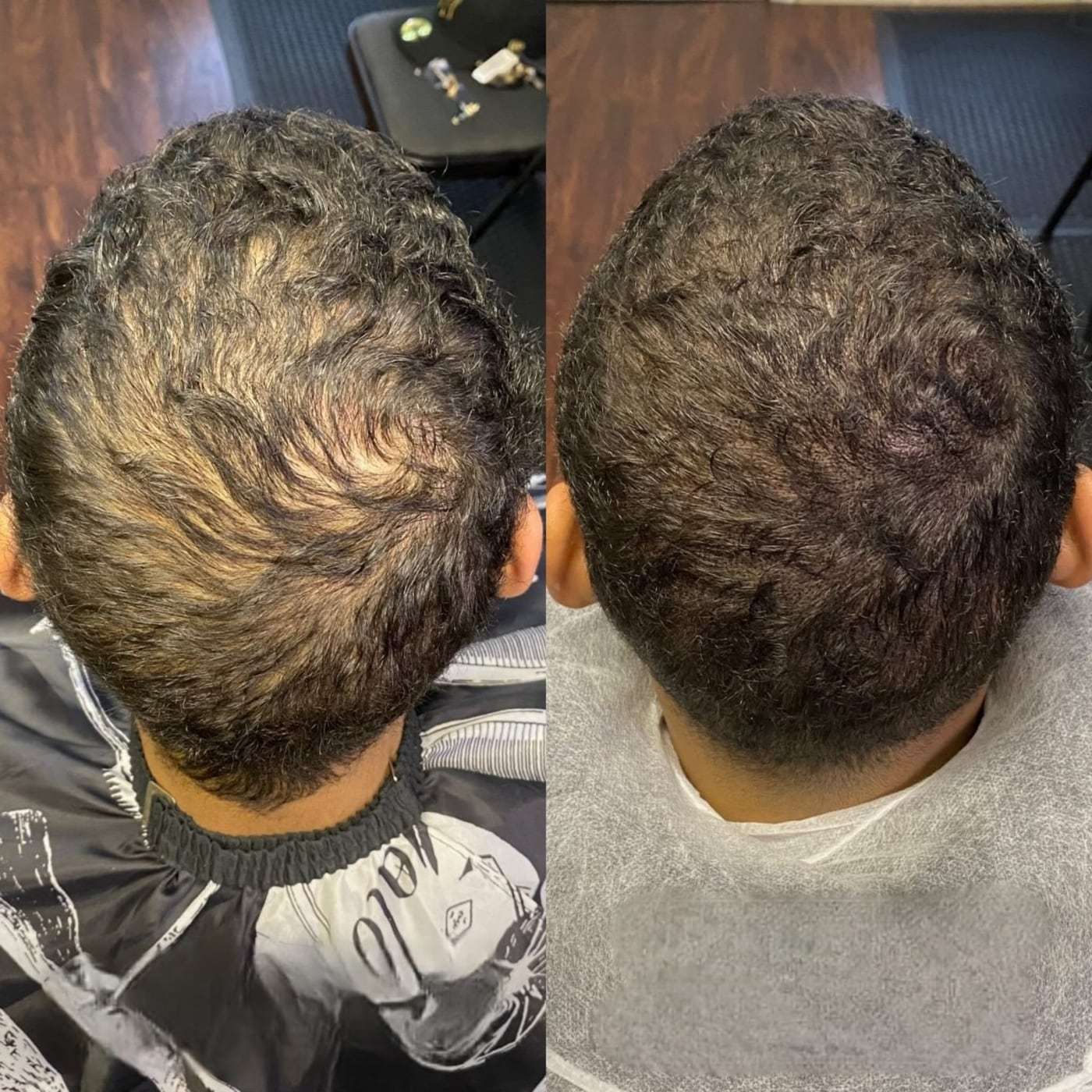 Scalp micropigmentation density, before and after (1 of 16)