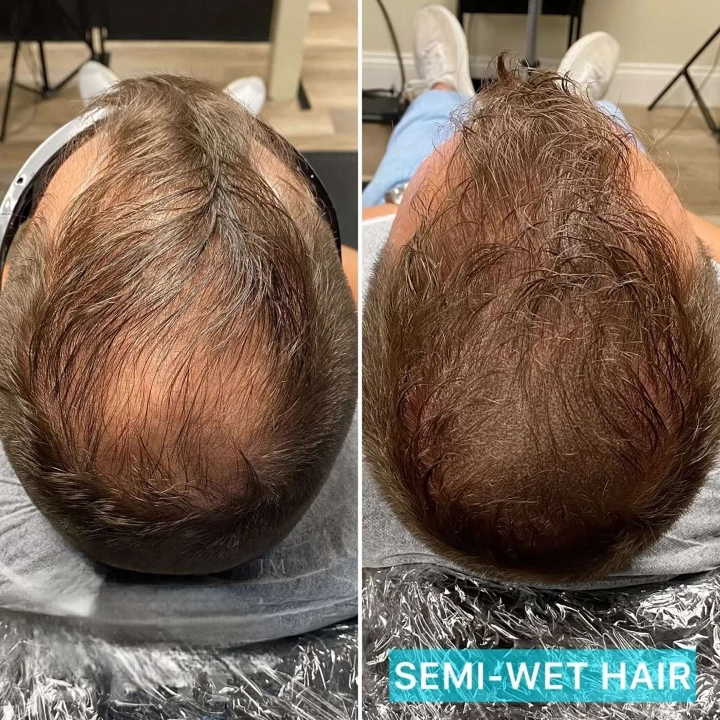 Scalp micropigmentation density, before and after (4 of 16)