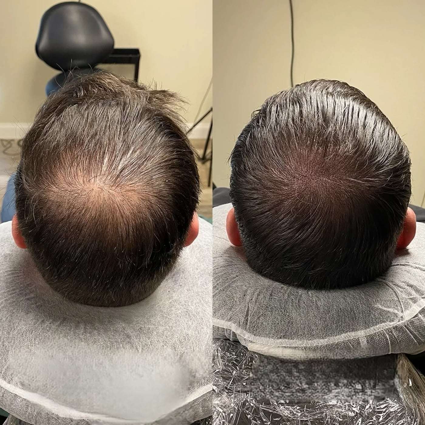 Scalp micropigmentation density, before and after (5 of 16)