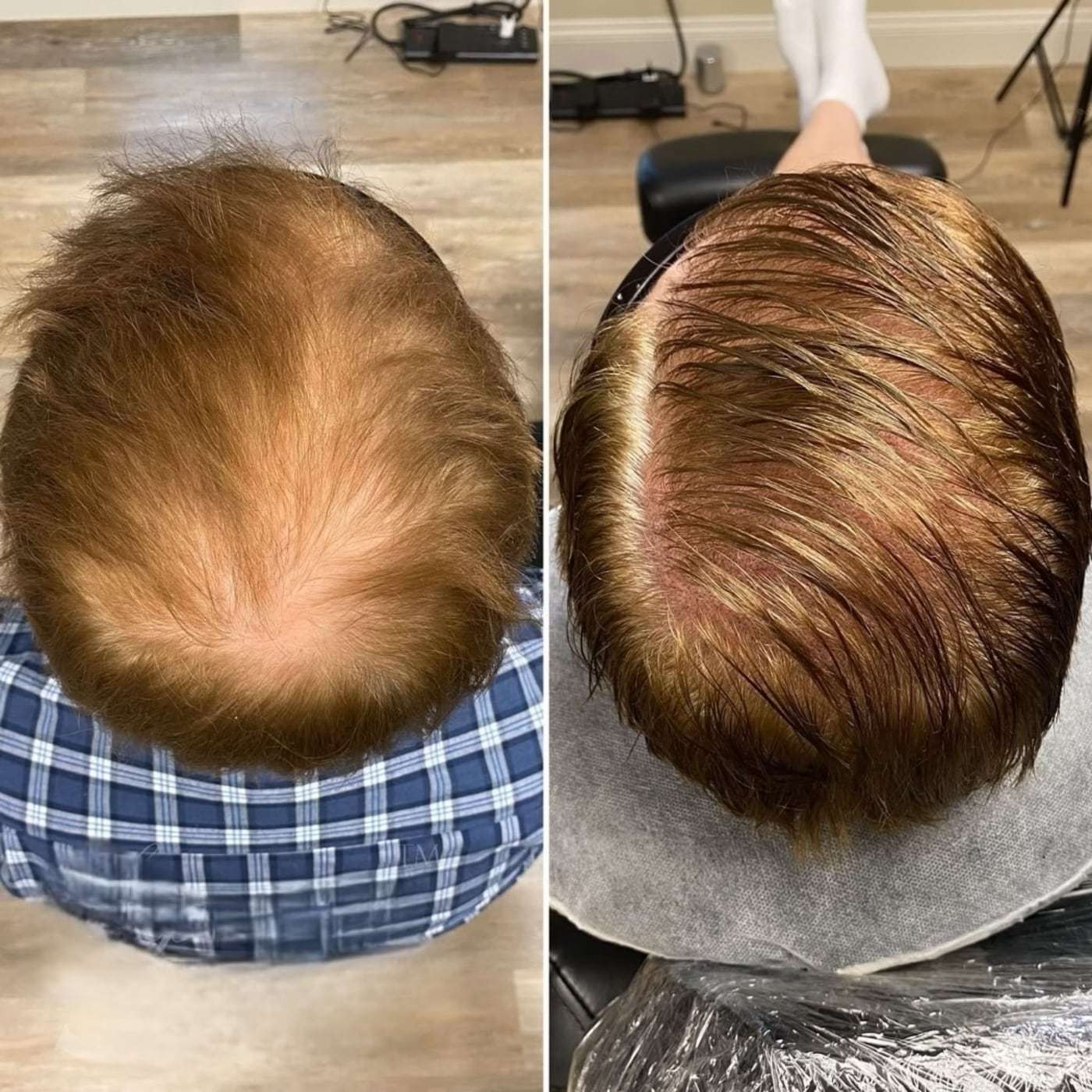 Scalp micropigmentation density, before and after (8 of 16)