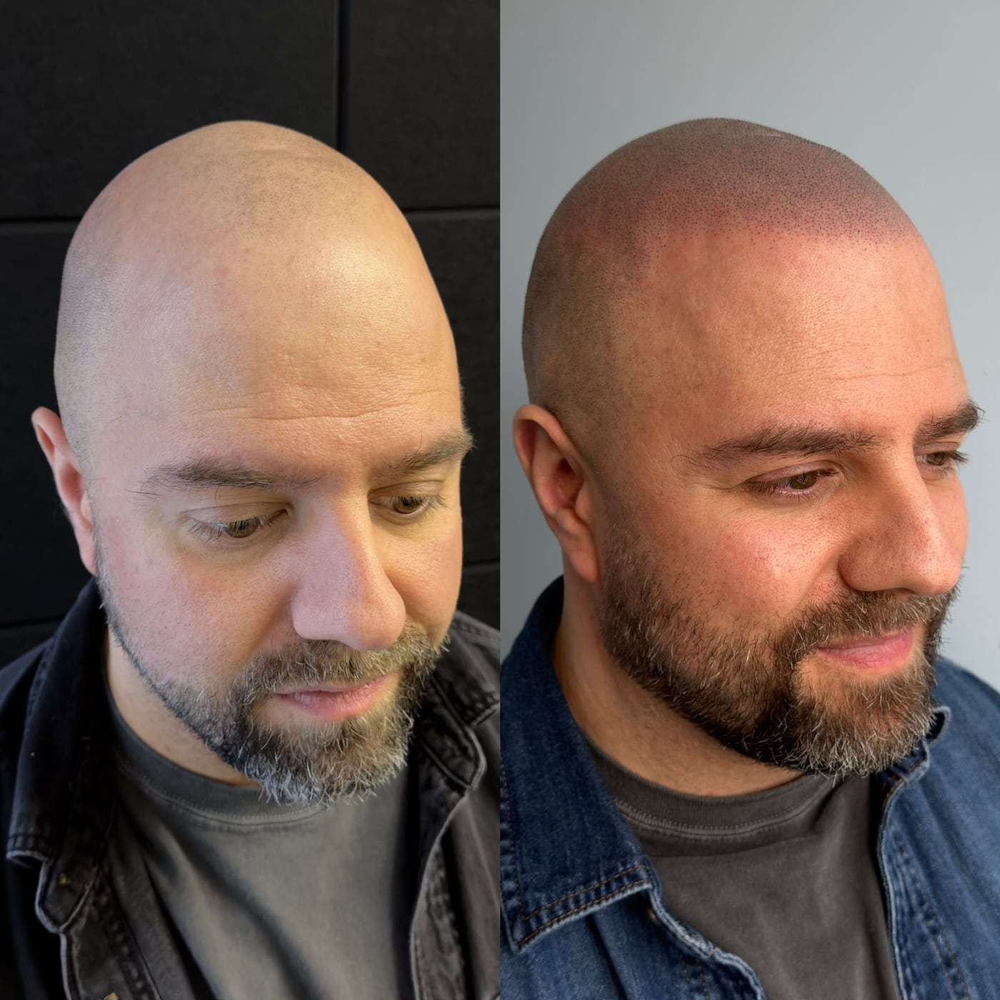 Before and after scalp micropigmentation, a man with a shaved head