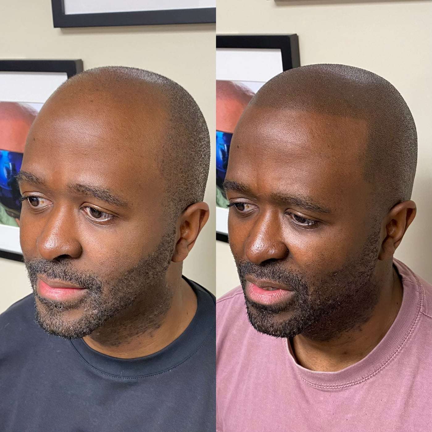 Before and after scalp micropigmentation hairline, a man in sunglasses