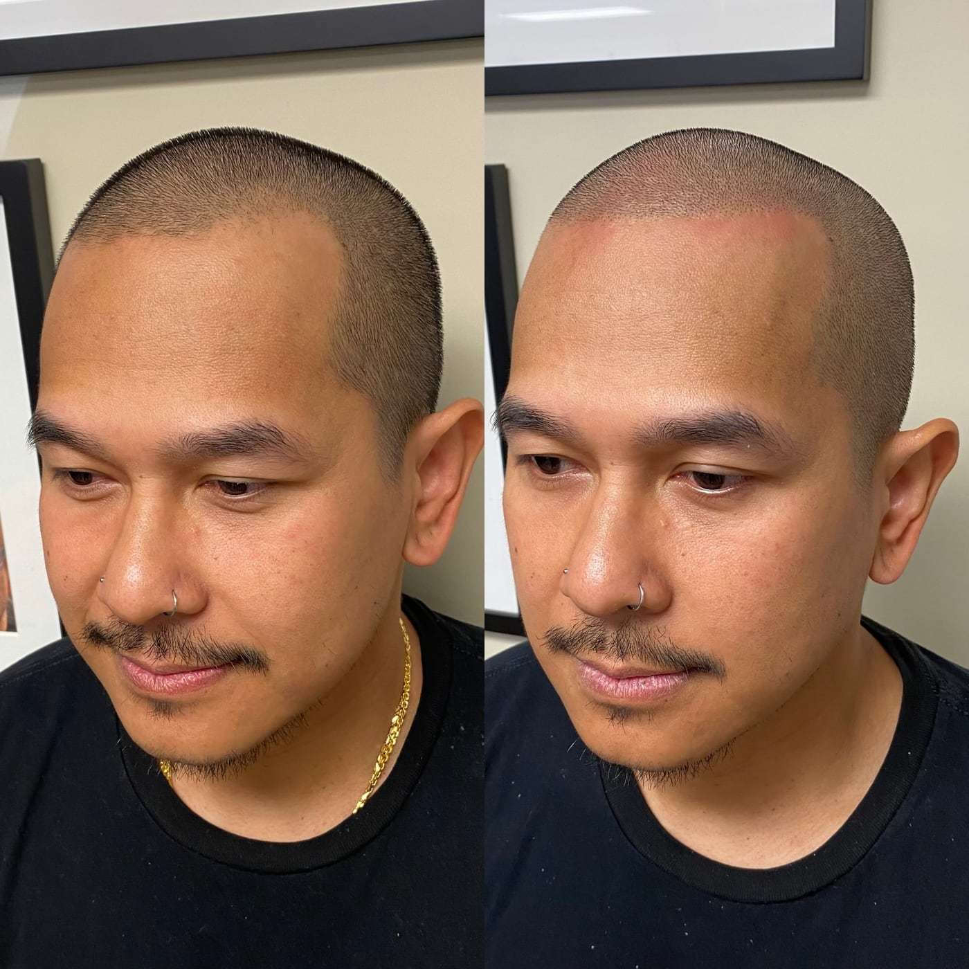 Before and after scalp micropigmentation, a man with a shaved head