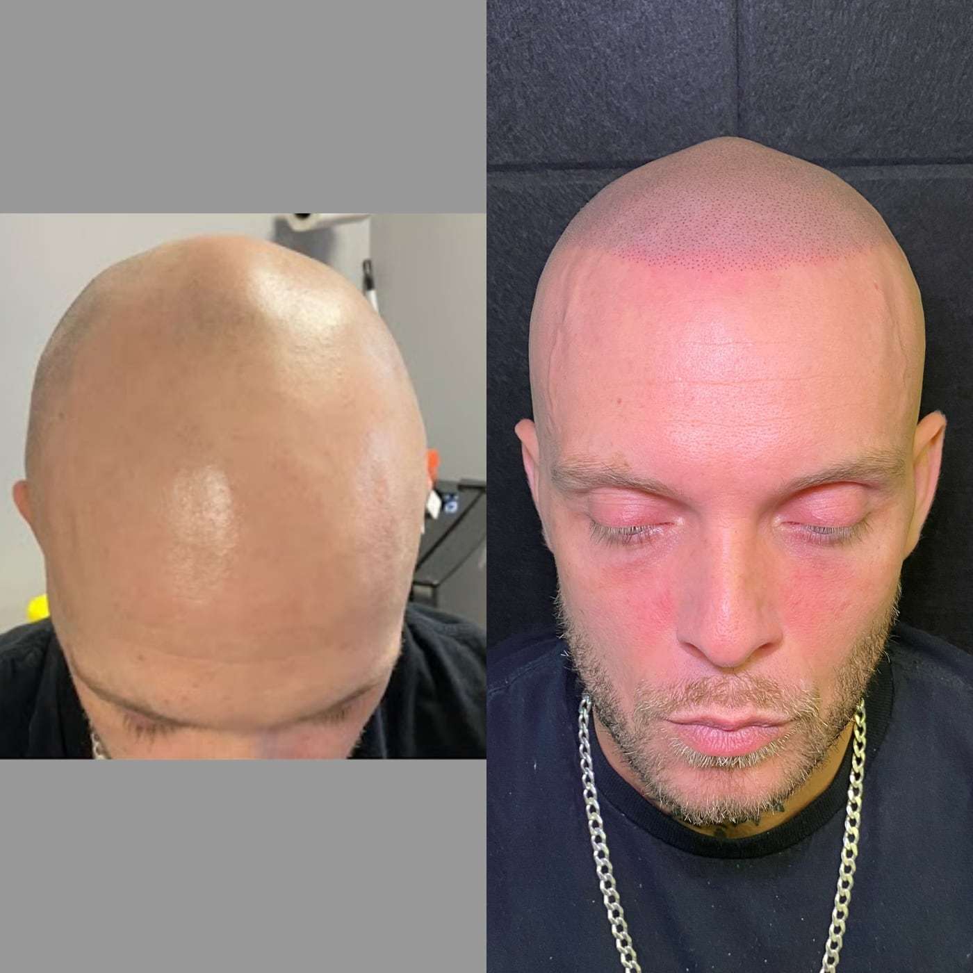 Before and after scalp micropigmentation hairline, a man with a beard