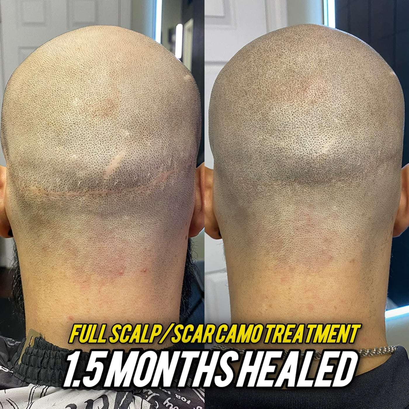 Scalp micropigmentation scarring, before and after (1 of 11)