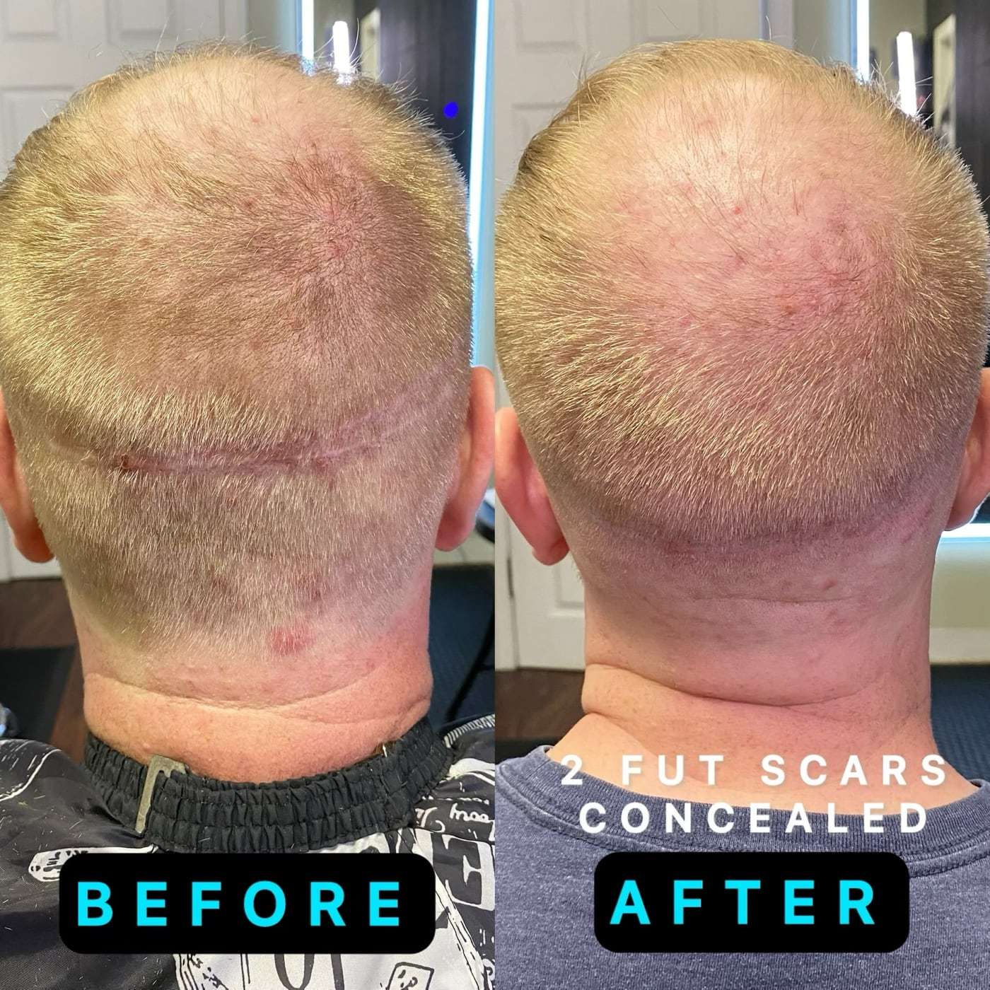 Scalp micropigmentation scarring, before and after (4 of 11)