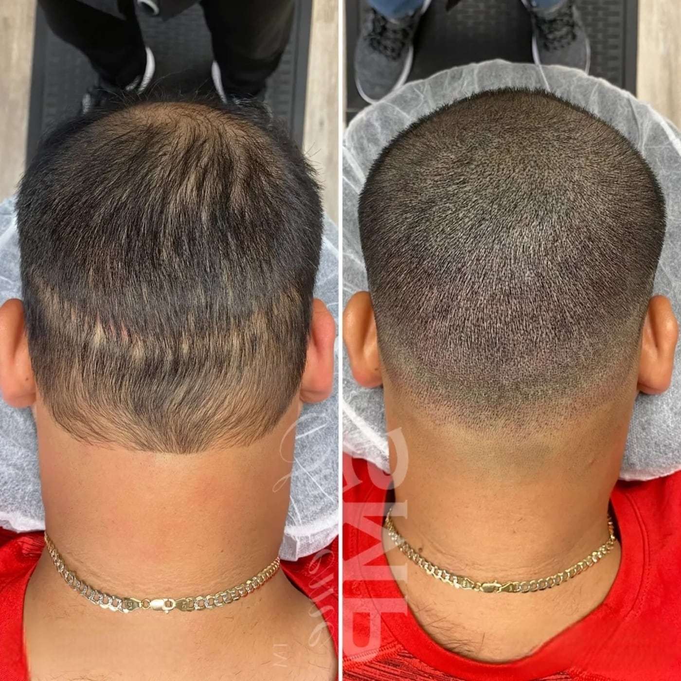 Scalp micropigmentation scarring, before and after (5 of 11)