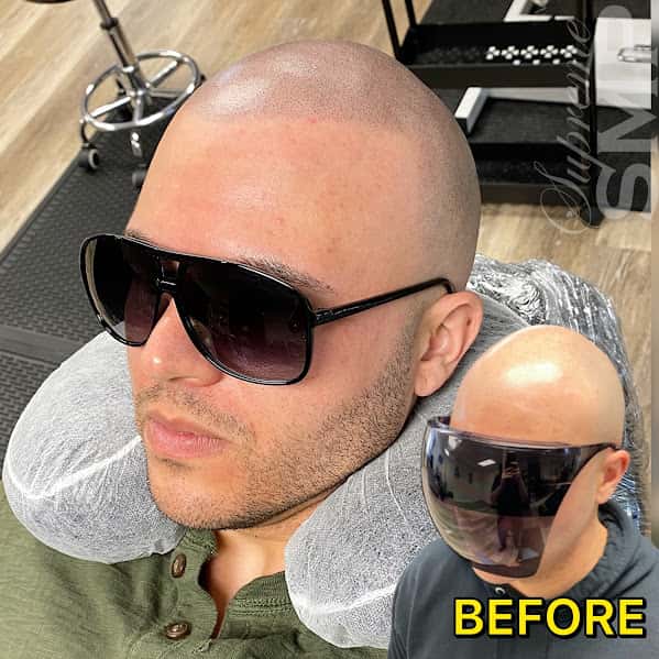 Scalp micropigmentation boston