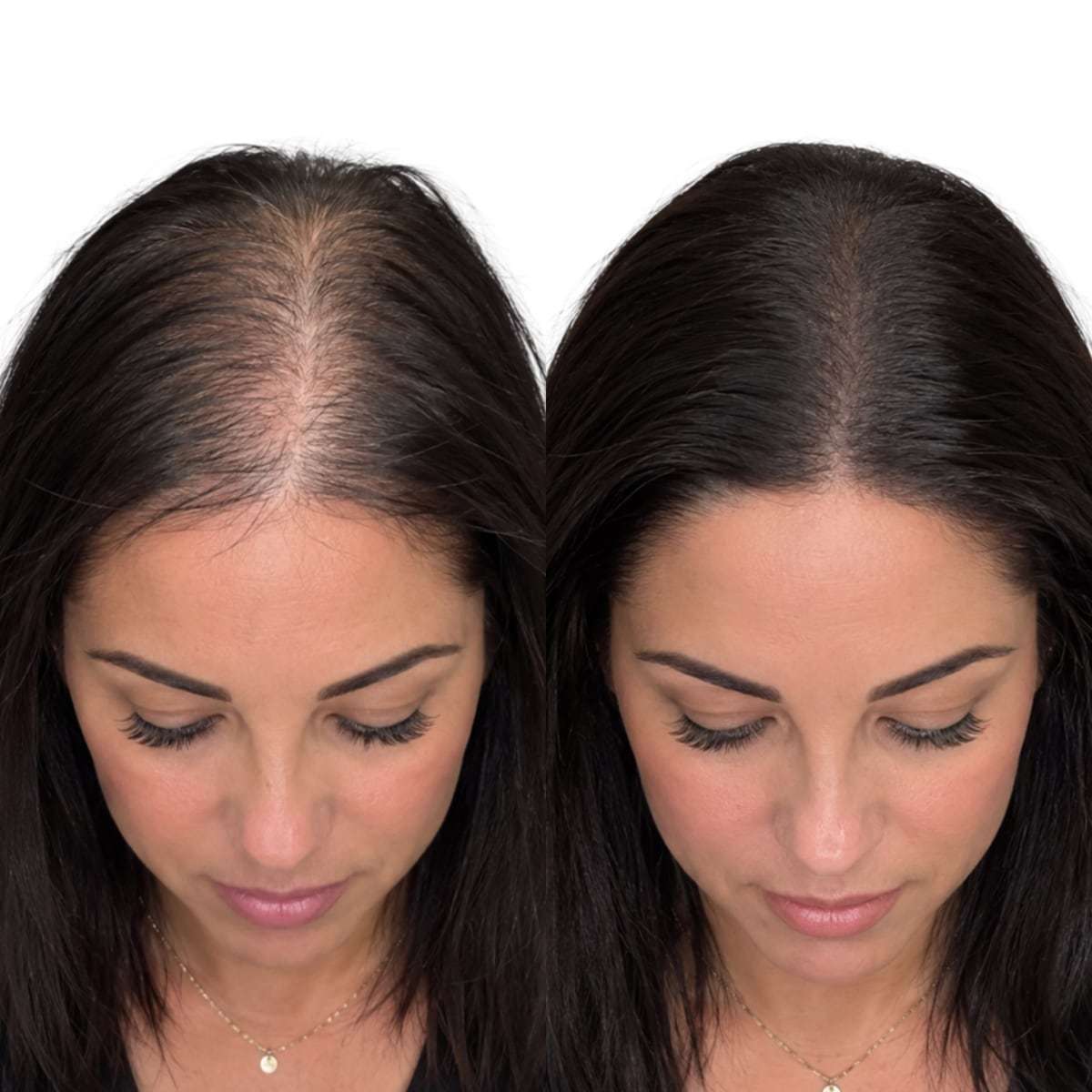 For Women, scalp micropigmentation result