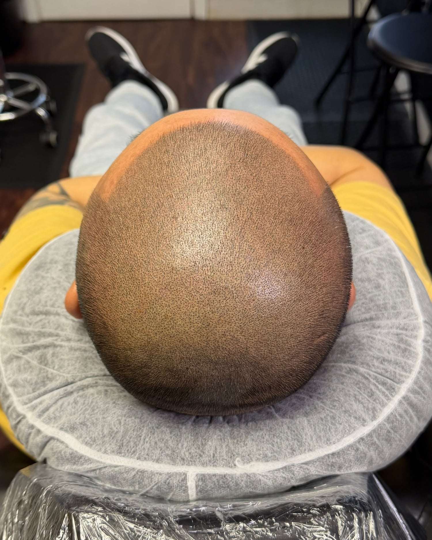 A scalp seen from above after scalp micropigmentation