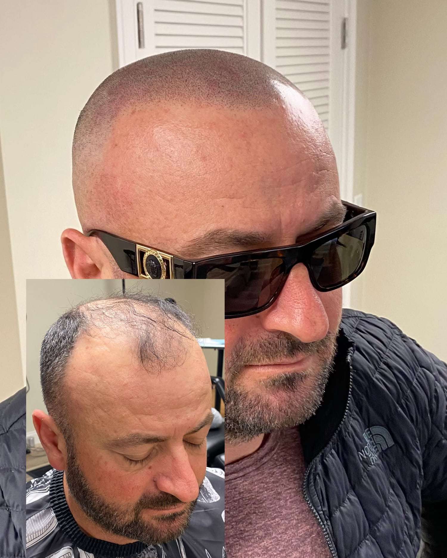 A man in sunglasses with a shaved head after scalp micropigmentation, and a before photo