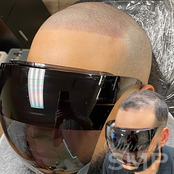 Bryan andover scalp micropigmentation: supreme smp