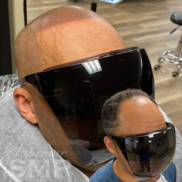 Boston scalp micropigmentation results