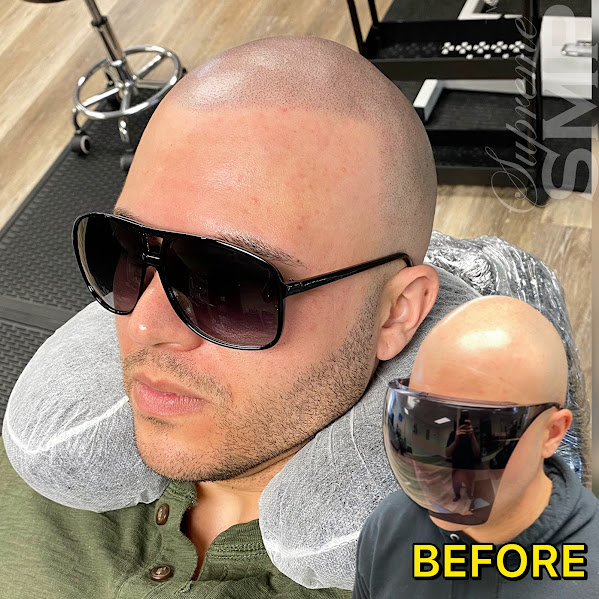 Scalp micropigmentation boston
