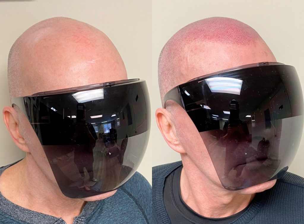 What smp actually does to a receding hairline e1782115553600: supreme smp What smp actually does to a receding hairline e1782115553600: supreme smp