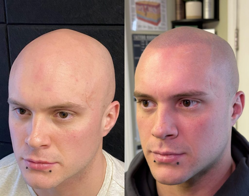 What scalp micropigmentation actually costs scaled e1783415773419: supreme smp What scalp micropigmentation actually costs scaled e1783415773419: supreme smp