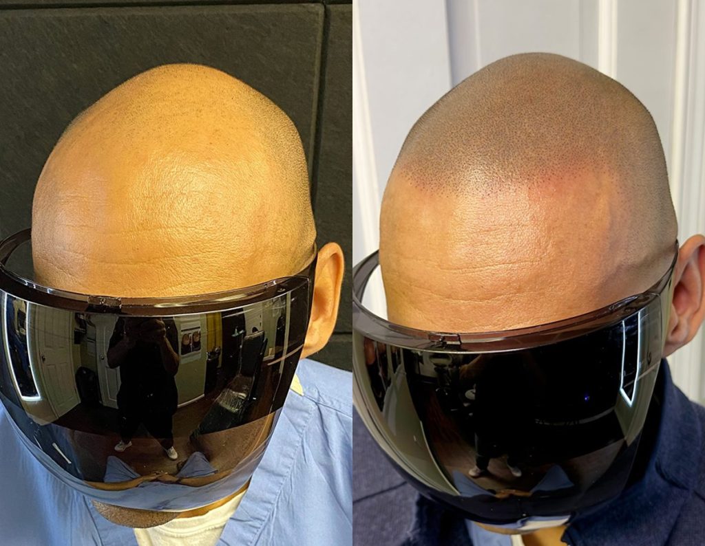 What the shaved head smp result actually looks like scaled e1783415673287: supreme smp What the shaved head smp result actually looks like scaled e1783415673287: supreme smp