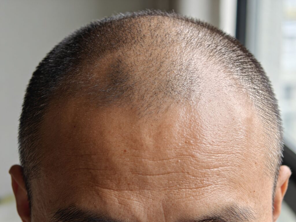 The shaved smp healing timeline, day by day